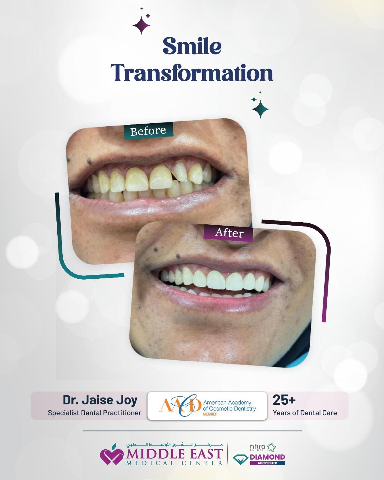 Advanced smile design